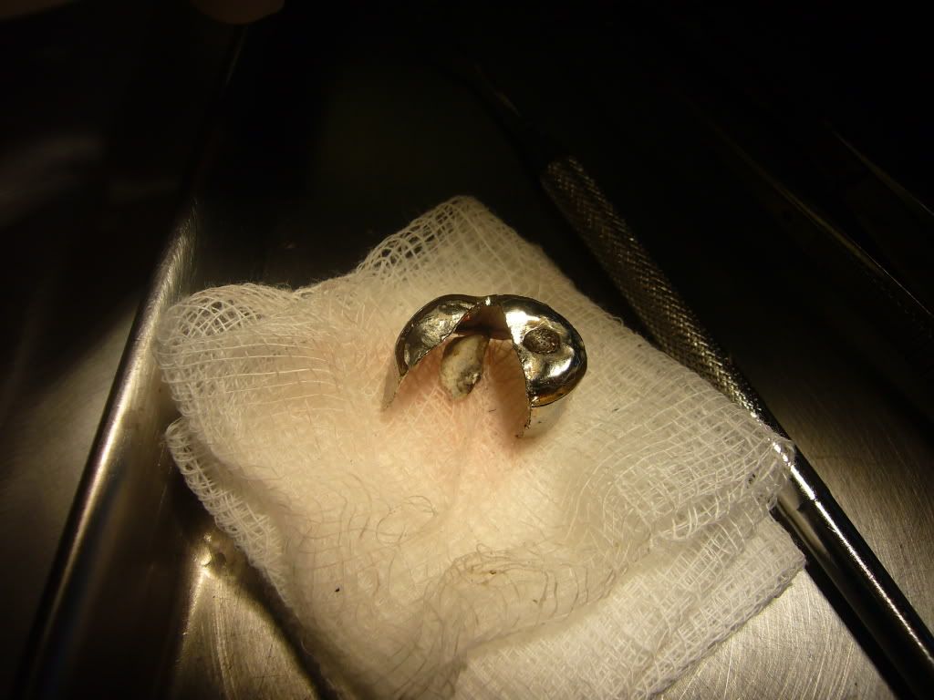 The disassembled prosthesis - occlusal view